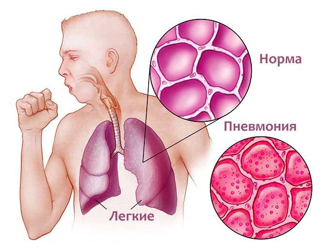 Диета 13 стол