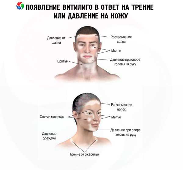 Депигментация кожи: главные причины и лечение | food and health