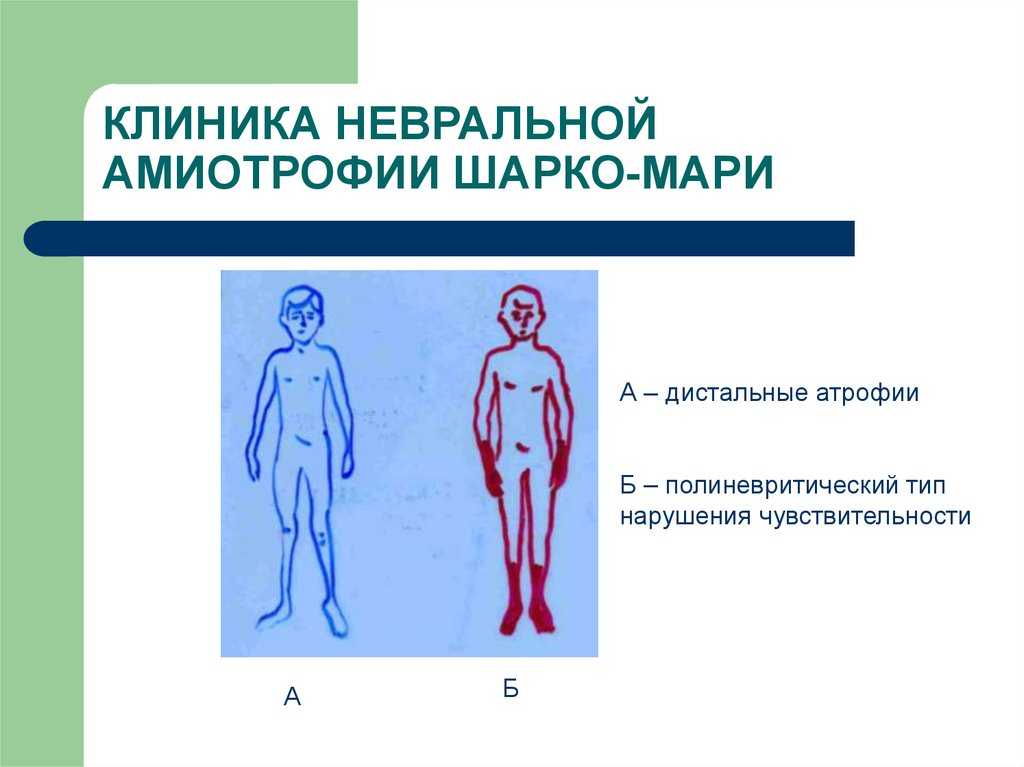 Болезнь шарко мари тута презентация