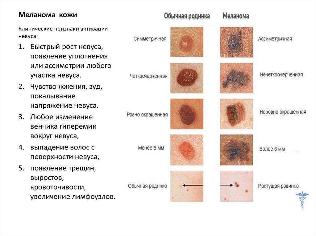 Кольцевидная эритема - признаки, причины, симптомы, лечение и профилактика - idoctor.kz