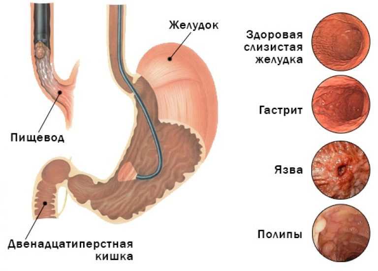 Эрозивный бульбит схема лечения