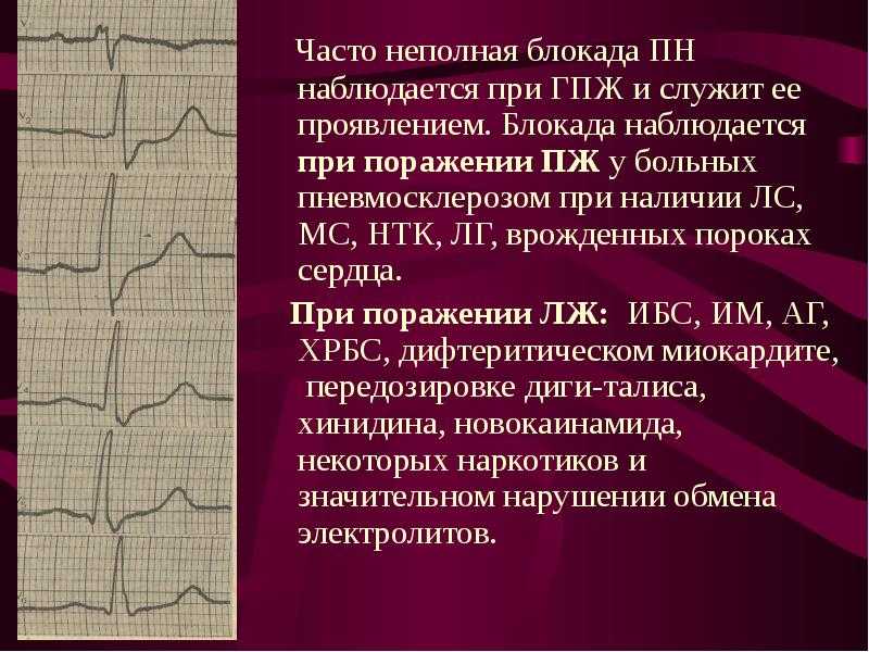 Внутрипредсердная блокада – причины, симптомы, диагностика и лечение в «клинике современной медицины иаки»