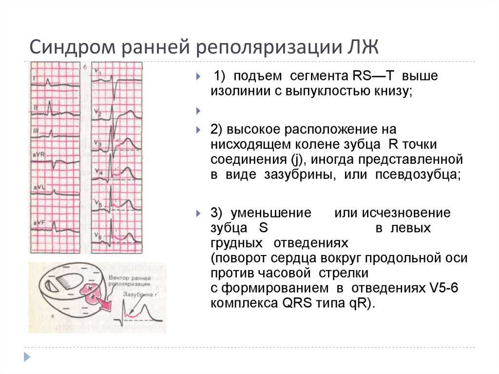 Синдром ранней реполяризации желудочков