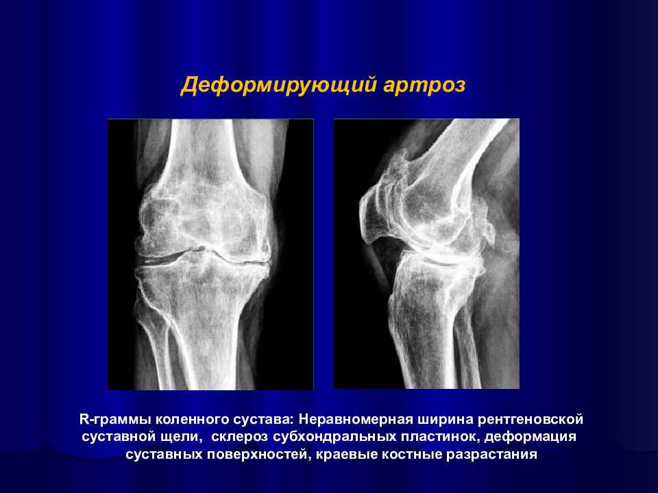 Гонартроз коленного сустава: что это, симптомы, причины, лечение и статистика