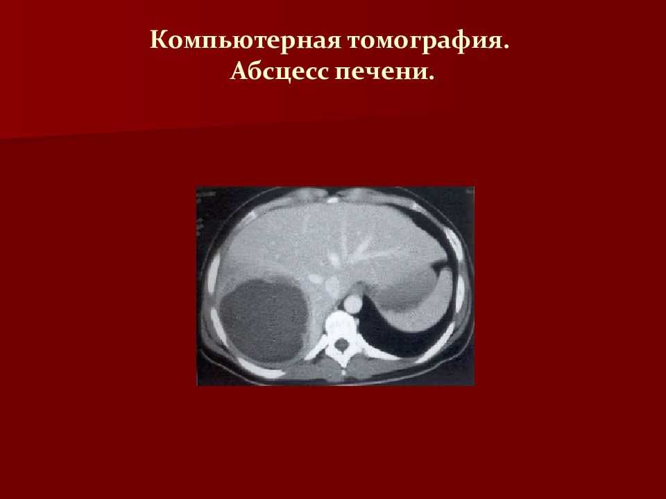 Абсцесс