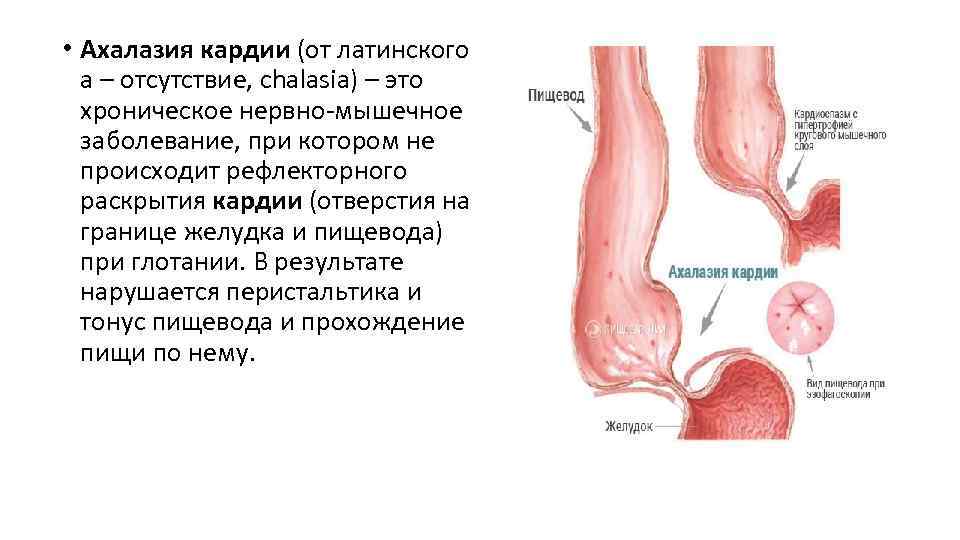 Диета при гастроэзофагеальной рефлюксной болезни | университетская клиника