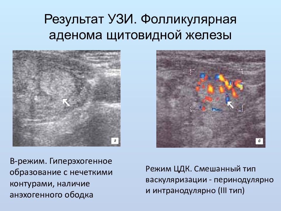 Узи щитовидной железы картинки