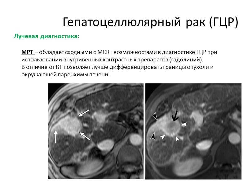 Гепатоцеллюлярный рак презентация