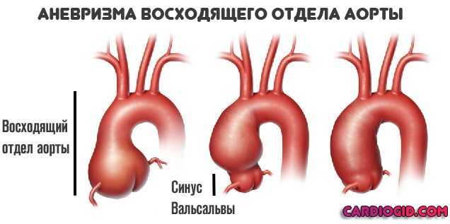 Аневризма отдела аорты. Аневризмы восходящего отдела аорты классификация. Классификация аневризм восходящего отдела аорты. Нормальный диаметр восходящего отдела грудной аорты. Аневризматическое расширение восходящего отдела грудной аорты.