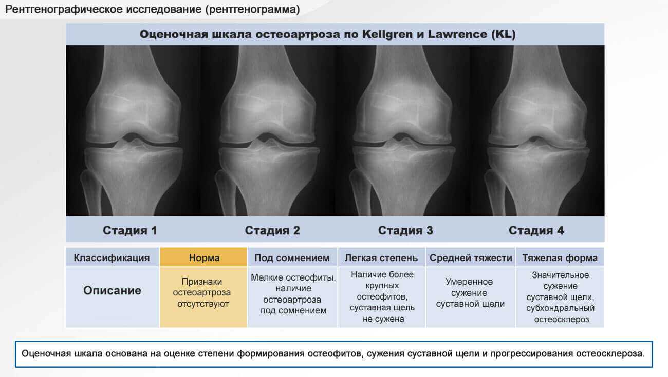 Полиостеоартроз ‒ самый опасный из всех видов артроза? - noltrexsin