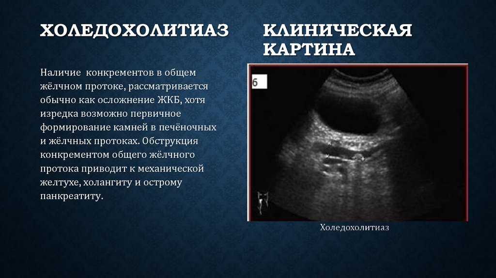 Желчекаменная болезнь * клиника диана в санкт-петербурге