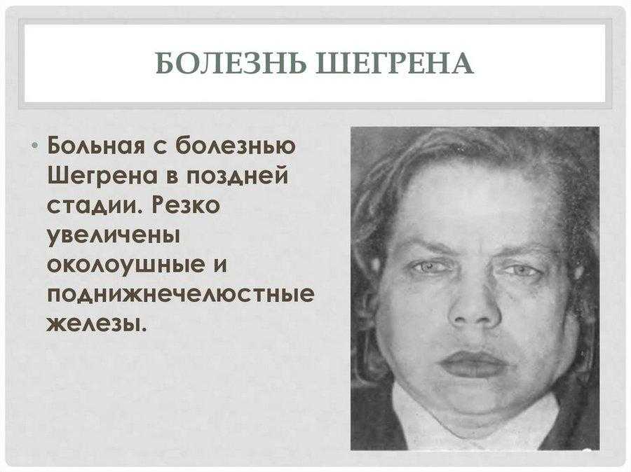 23 июля - день синдрома шегрена - бу "миац" минздрава чувашии