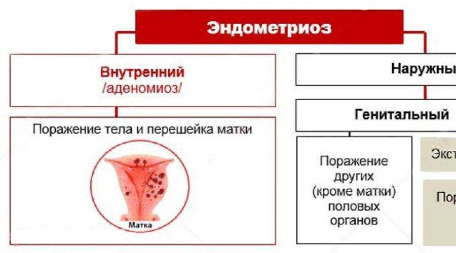 Аденомиоз матки