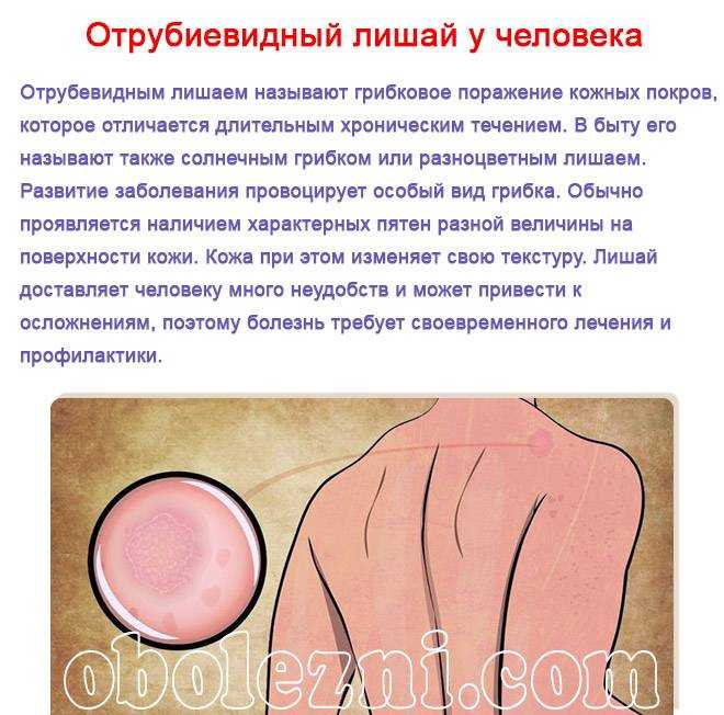 Розовый лишай: причины, диагностика, лечение, профилактика