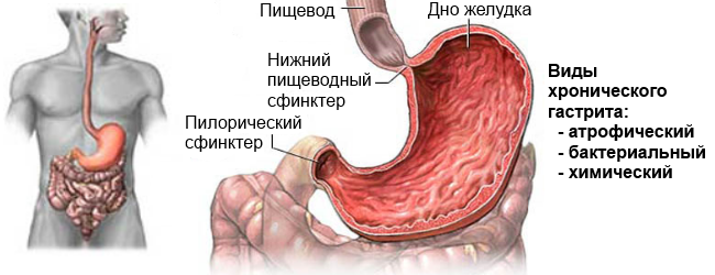 Питание при атрофическом гастрите желудка