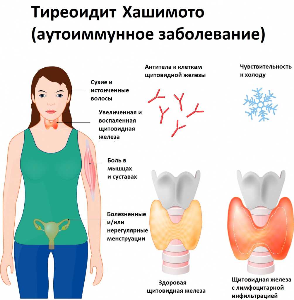 Жизнь после удаления щитовидной железы у женщин