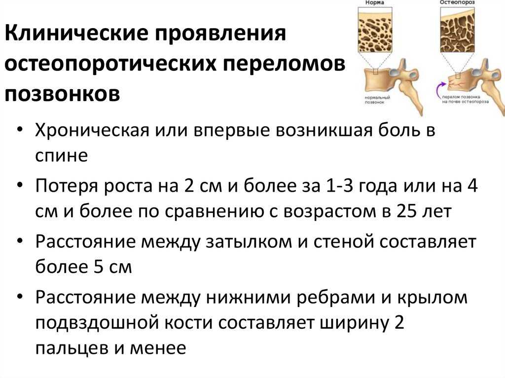 Остеопороз