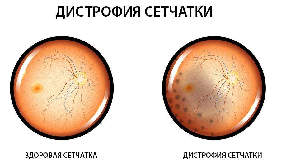 Очаговые изменения мозга: развитие, виды, симптомы, опасны или нет, как лечить