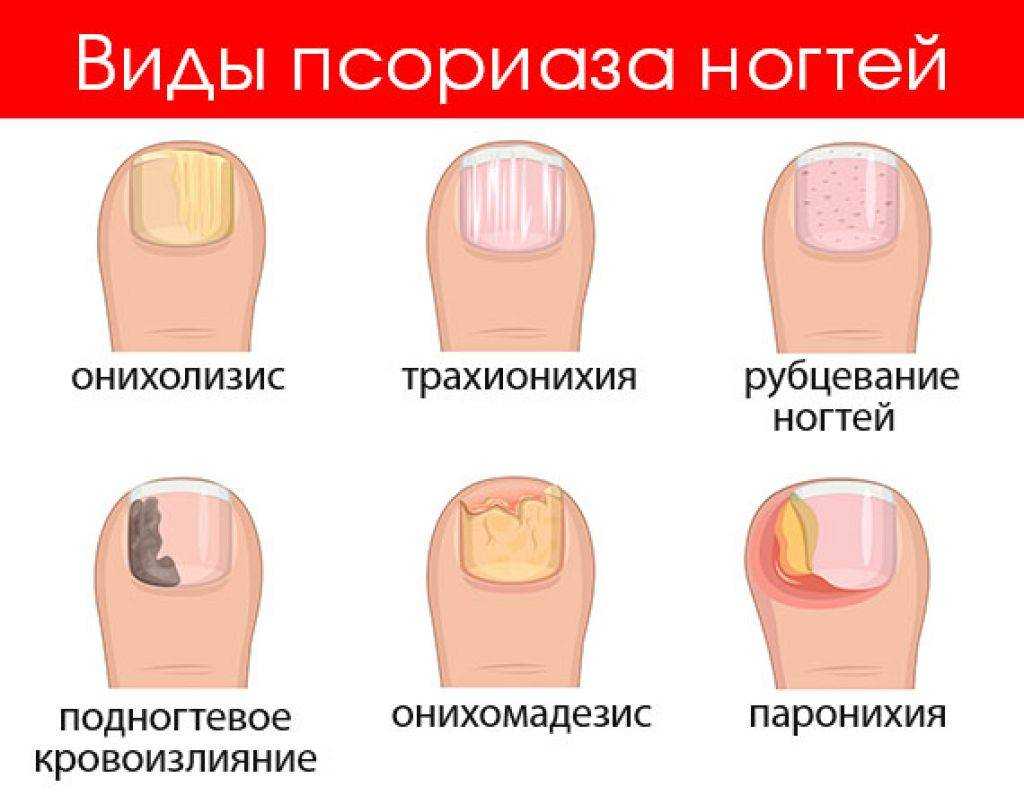 Онихомикоз