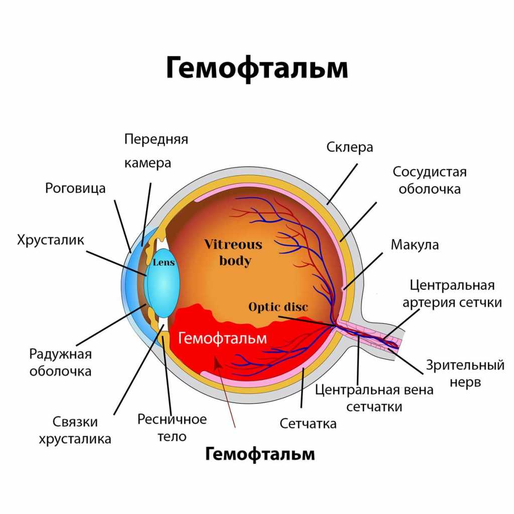 Кровоизлияние в стекловидное. Гемофтальм и деструкция. Травматический гемофтальм.