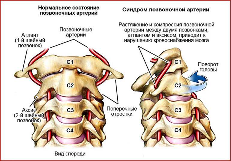 Шейная позвоночная артерия. Синдром экстравазальной компрессии позвоночной артерии. Сдавление позвоночной артерии шейного отдела. Синдром позвоночной артерии при шейном остеохондрозе. V4 сегмент позвоночной артерии.