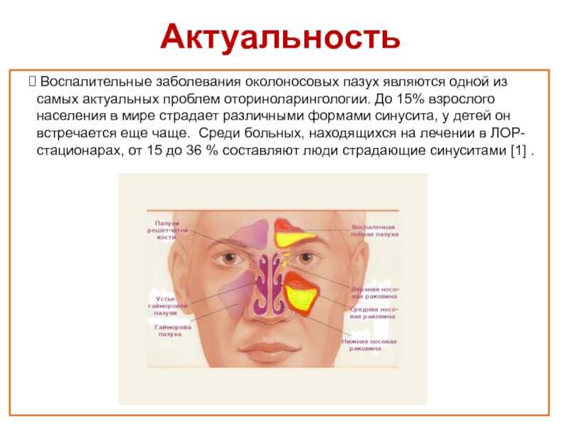 Синуситы - диагностика и лечение острых, хронических синуситов