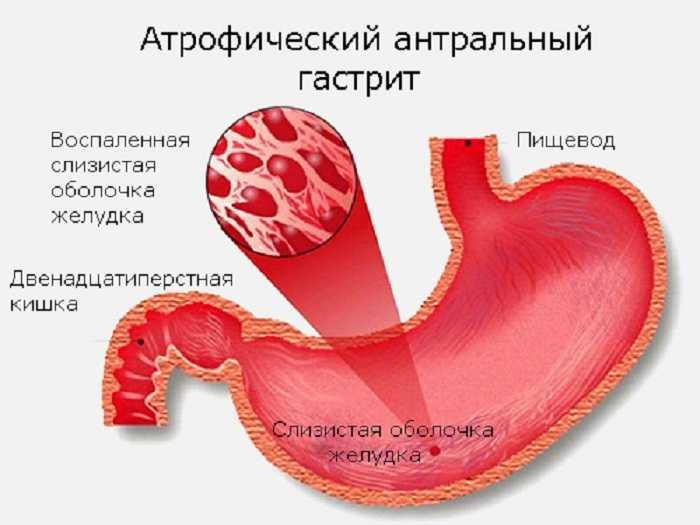 Ригидный антральный гастрит схема