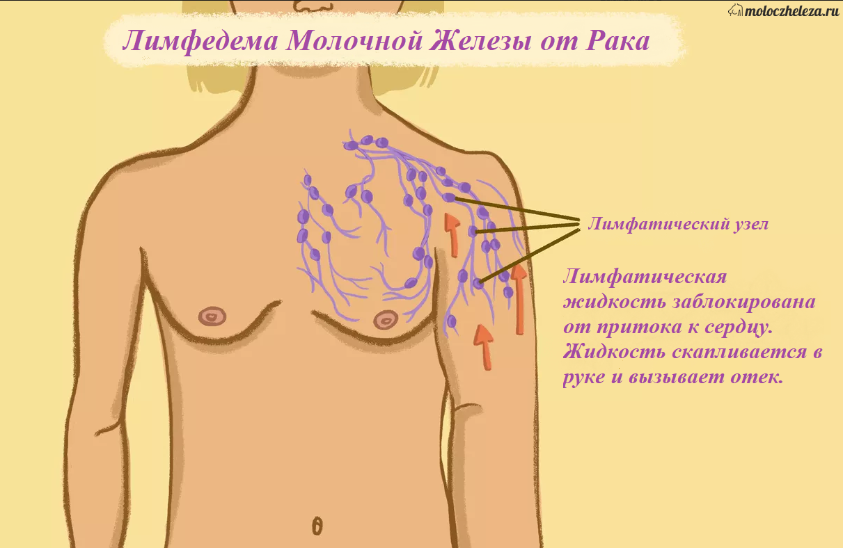 злокачественная опухоль в груди у женщин фото 113