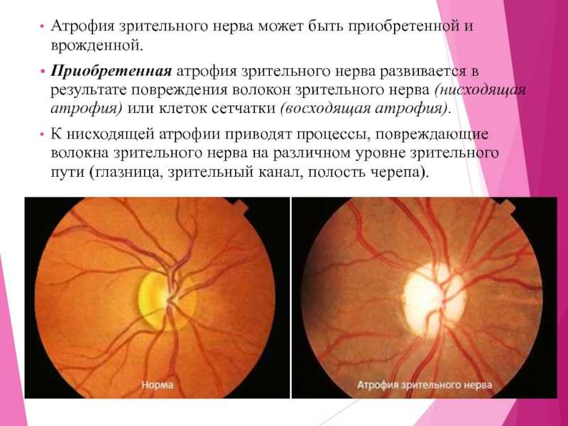 Лечение глазного нерва. Неврит зрительного нерва симптоматика. Патогенез атрофии зрительного нерва. Причины развития атрофии зрительного нерва.