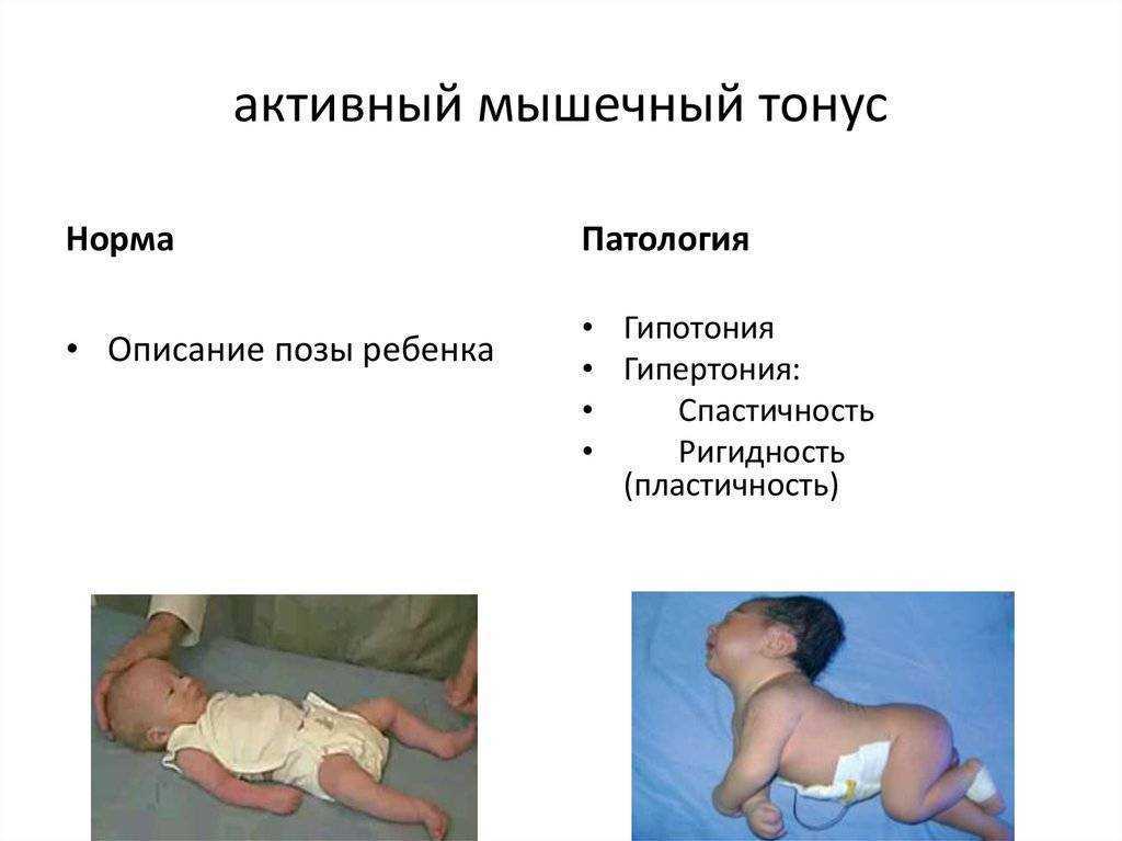 Сдн (синдром двигательных нарушений): лечение в минске