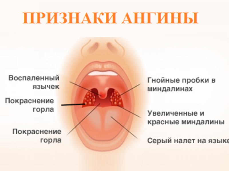 Острый тонзиллит код 10. Стрептококковая ангина. Гнойное воспаление миндалин.