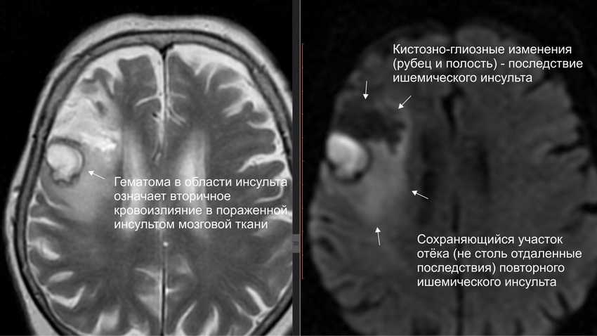 Кистозно-атрофические изменения головного мозга на кт. Послеоперационные кистозно глиозные изменения головного мозга мрт. Кистозно-глиозная трансформация головного мозга что это такое.
