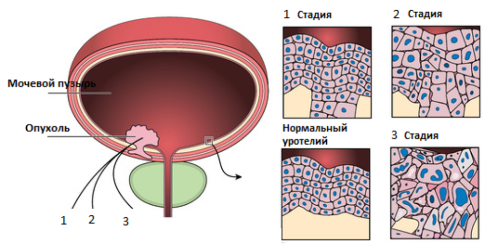 Паравезикальная клетчатка. Опухоли мочевого пузыря патогенез. Новообразования мочевого пузыря классификация. Злокачественные новообразования мочевого пузыря классификация. Клинические проявления опухоли мочевого пузыря.