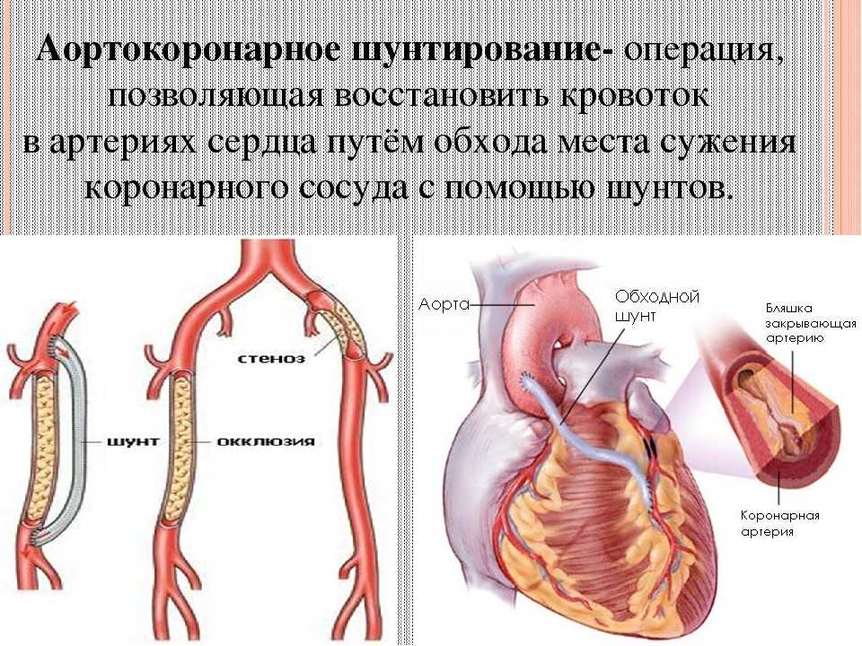 Шунтирование сердца ▷ методы, риски, клиники