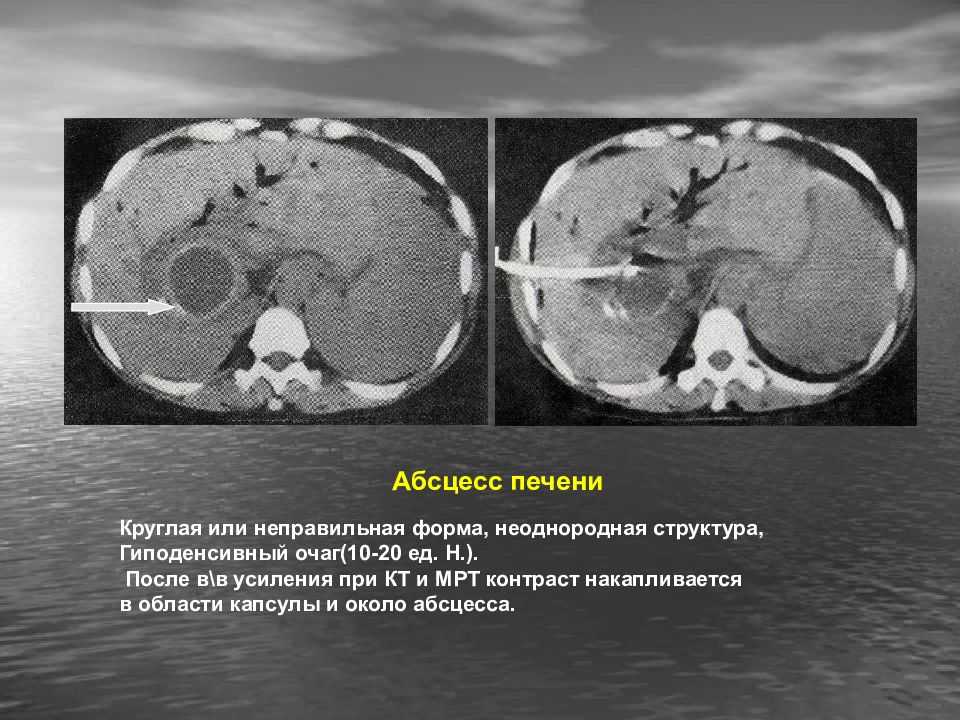 Абсцесс печени. Подпеченочный абсцесс печени кт. Холангиогенные абсцессы печени. Подпеченочный абсцесс мрт. Пиогенный абсцесс печени.