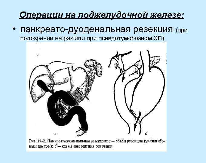 Острый панкреатит