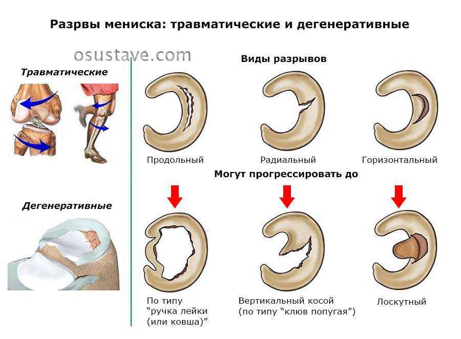 Дегенеративные процессы в суставах – простыми словами - нолтрекс.