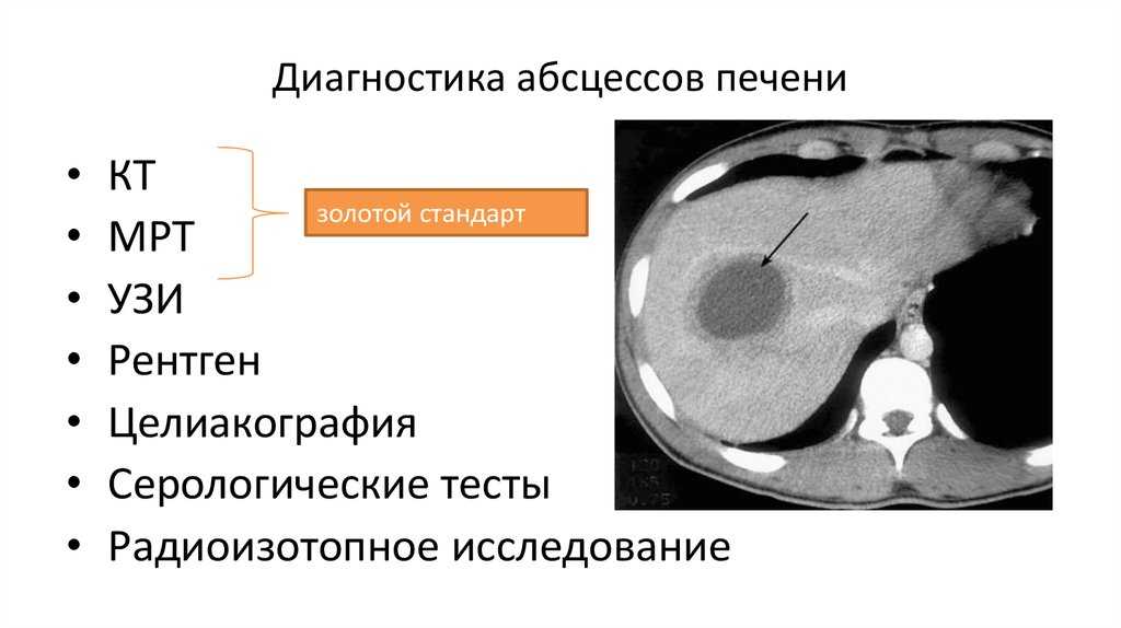 Абсцедирующая пневмония