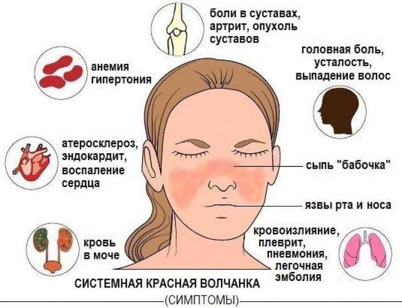 Системная красная волчанка: особенности диагностики и лечения * клиника диана в санкт-петербурге