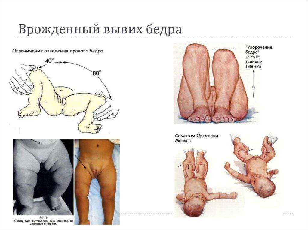 Влияние дисплазии соединительной ткани на развитие пролапса гениталий
 - vmc verte medical clinic