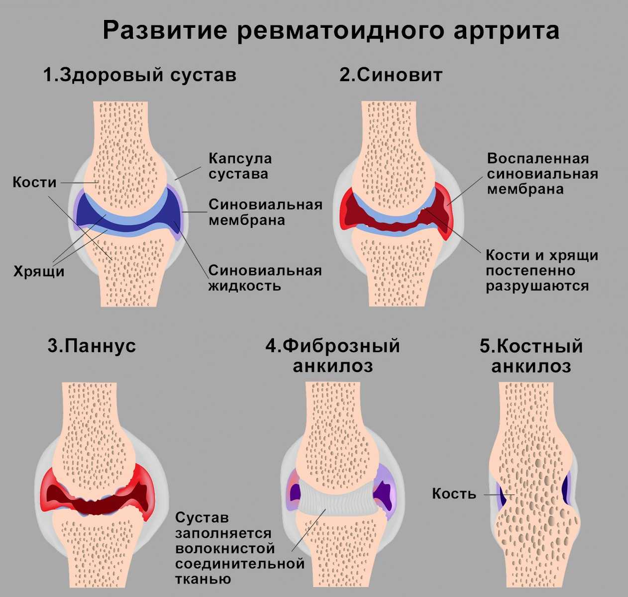 Артрит: виды, причины и симптомы заболевания. какой врач лечит артрит?