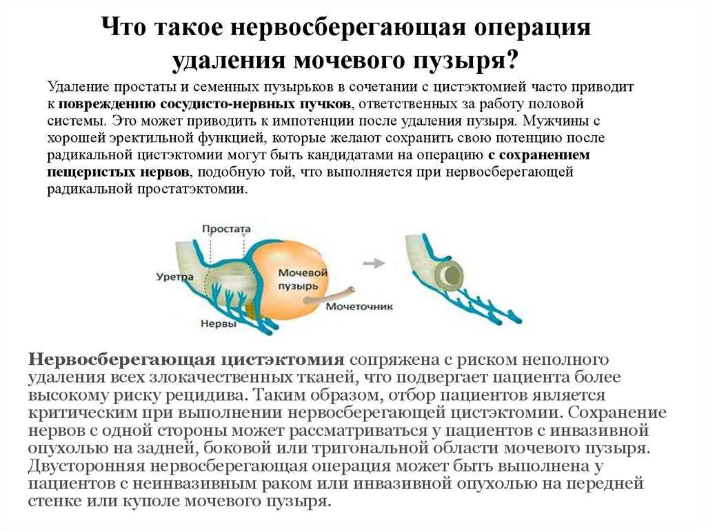 Рак простаты у мужчин: диагностика и профилактика заболевания