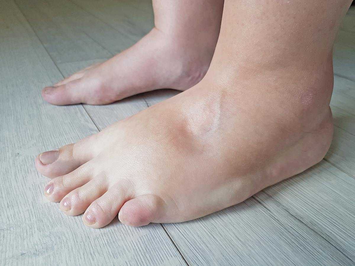 Рекомендации для снятия отека ног