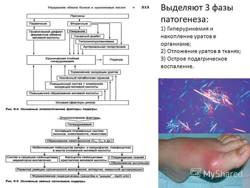 Гиперурикозурия и гиперурикемия