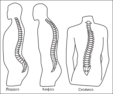 Лордоз кифоз картинки