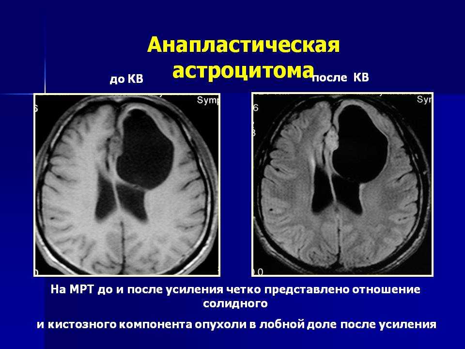 Кистозно-глиозные изменения головного мозга: что это такое, лечение и последствия