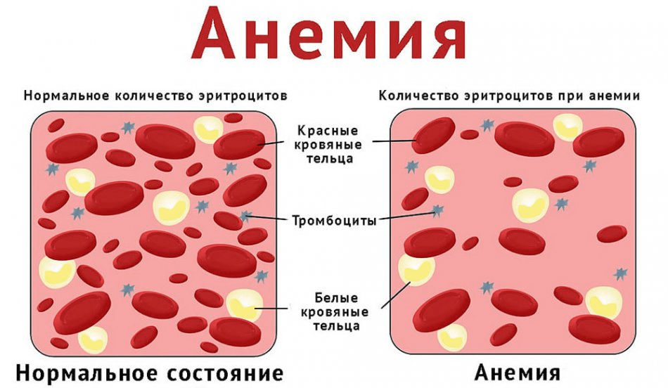 Диагностика анемии картинки