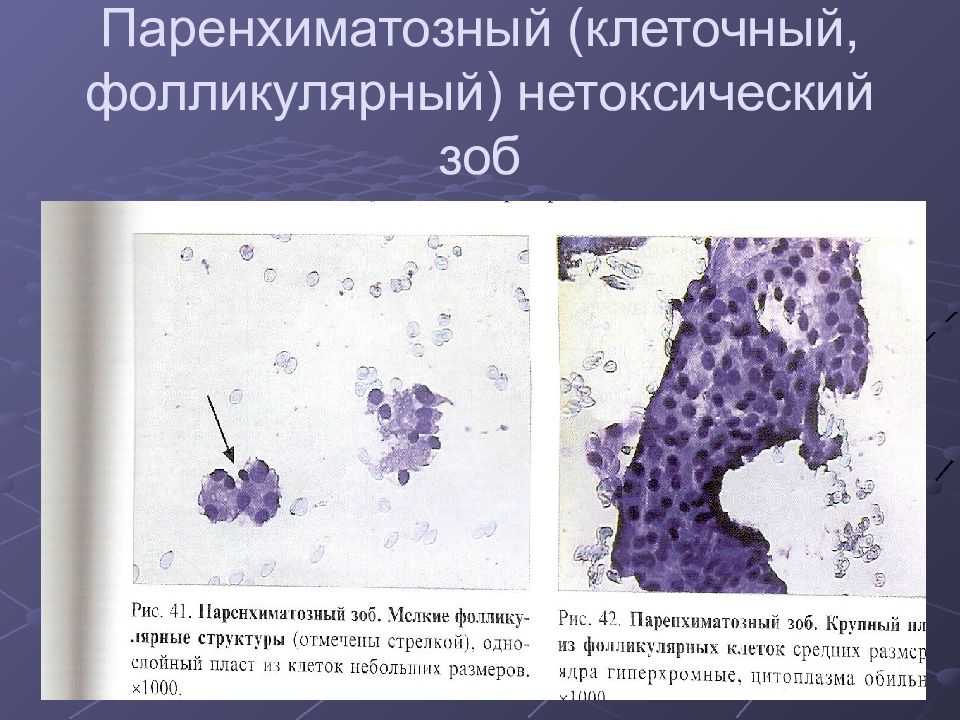 Функциональная киста яичников: нужна ли операция?