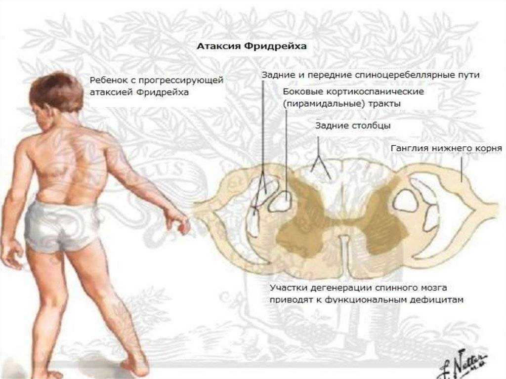Атаксия фридрейха: симптомы, диагностика, лечение