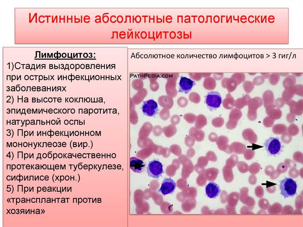 Общий лейкоцитоз. Картина крови при нейтрофильном лейкоцитозе. Лейкоцитоз с лимфоцитозом. Снижение количества лимфоцитов. Изменения периферической крови.